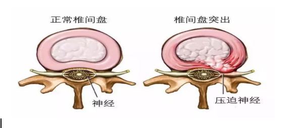 關(guān)注健康  、從保護脊柱開始