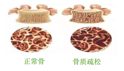 健康骨骼  遠(yuǎn)離骨質(zhì)疏松