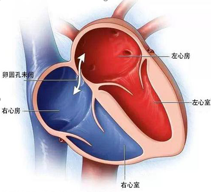 偏頭痛的痛誰懂？發(fā)泡實驗“@了你”