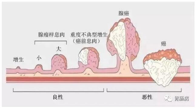 年輕人用不著查腸鏡？不一定的